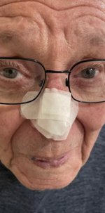 Mohs nasal wound, step 2