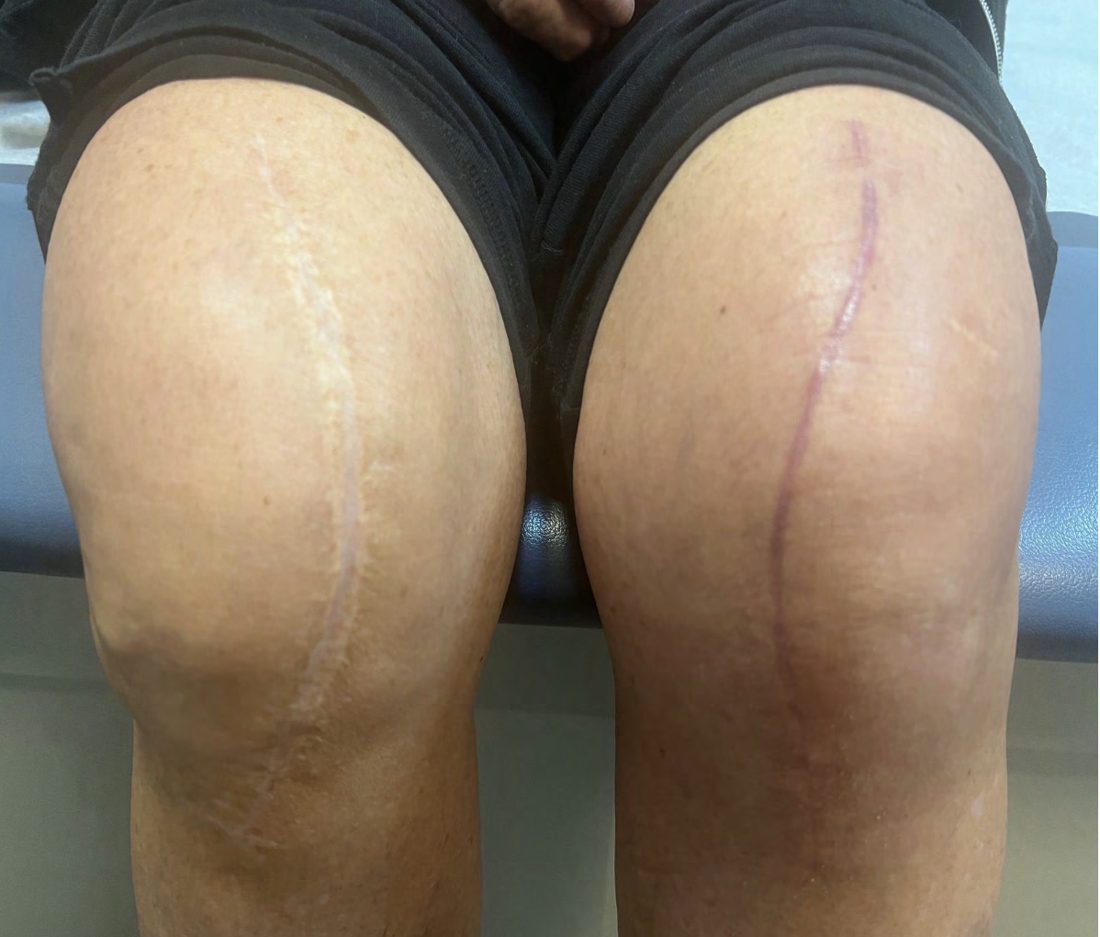 Same patient after two total knee replacements: left incision dehisced without a CareKit, right incision closed cleanly with a VERIS&trade; CareKit