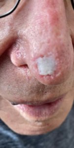 Mohs nasal wound, step 2