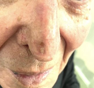 Mohs nasal wound, step 3
